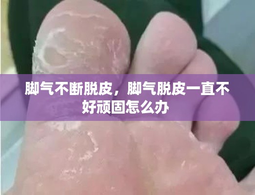 脚气不断脱皮，脚气脱皮一直不好顽固怎么办 