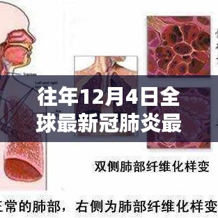 往年12月4日全球新冠肺炎最新消息综述