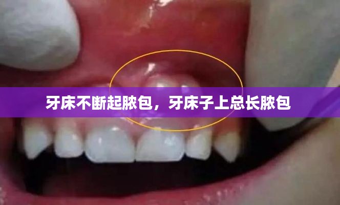 牙床不断起脓包，牙床子上总长脓包 