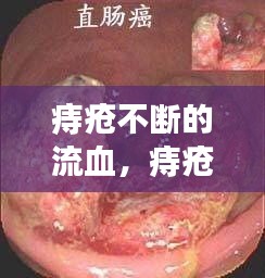 痔疮不断的流血，痔疮不断流血不止 