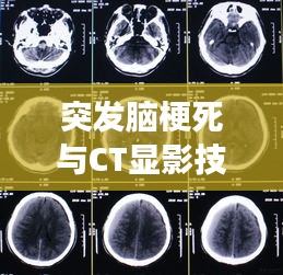 突发脑梗死与CT显影技术，现代医学的精准洞察之旅